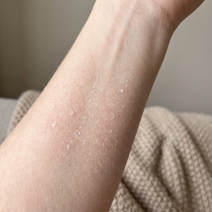 Dry, itchy skin