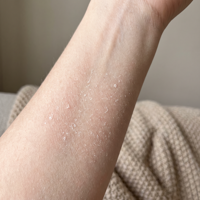 Dry, sensitive skin