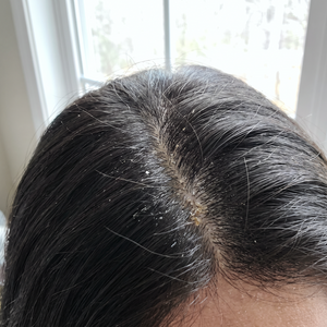 Itchy, flaky scalp